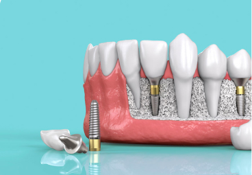 Nguyên nhân khiến việc cấy ghép implant bị thất bại