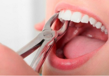 Những Điều Cần Biết khi nhổ răng tiểu phẫu