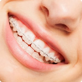 Niềng răng bằng mắc cài sứ – Mức độ 1