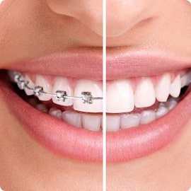 Niềng răng bằng mắc cài sứ – Mức độ 1
